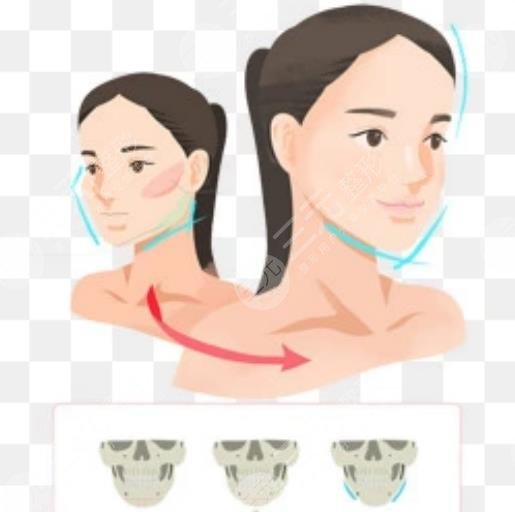 磨骨瘦臉多少費用