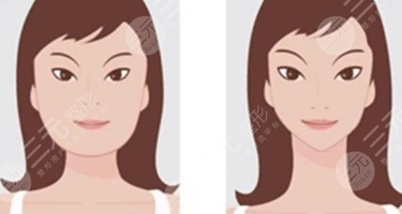 磨骨瘦臉多少費用