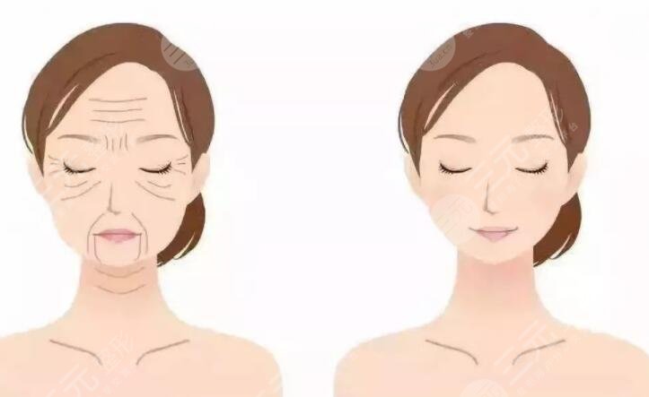 什么是筋膜重整？