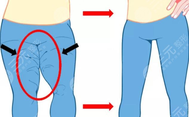 光纖溶脂術(shù)后護理方法有哪些?