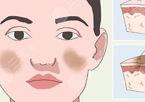 激光祛斑后反黑怎樣能快速消除？