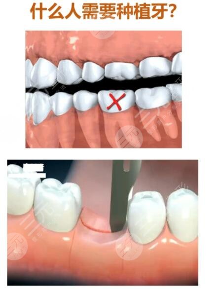 種植牙的注意事項有哪些?