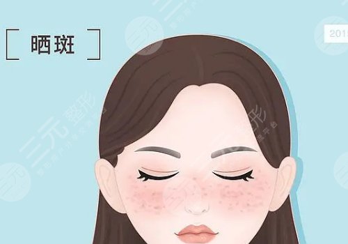 曬斑如何淡化或去掉？