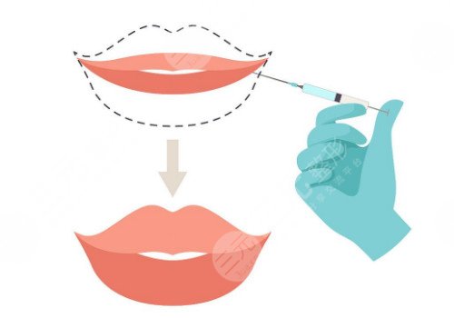 唇部注射玻尿酸需要注意什么？