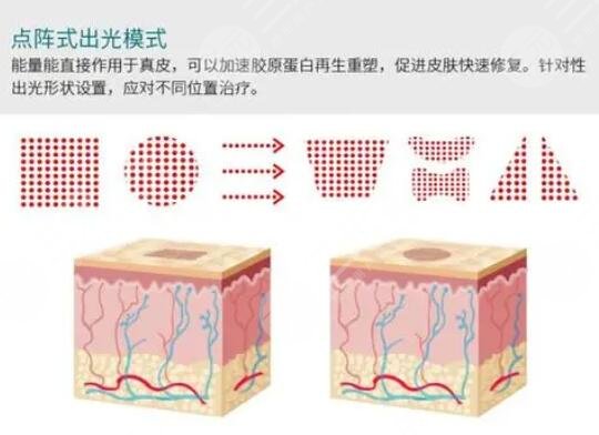 點(diǎn)陣像素激光是什么效果?