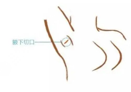 隆胸腋下切口的優(yōu)勢(shì)和缺點(diǎn)有哪些？