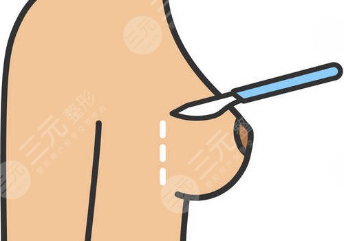 隆胸腋下切口的優(yōu)勢(shì)和缺點(diǎn)有哪些？