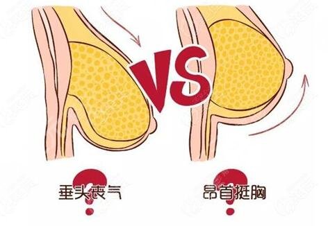 下垂胸怎么矯正有效果？手術(shù)與非手術(shù)方法都可選！產(chǎn)后媽媽的救星！