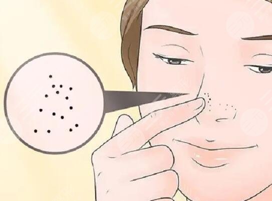 黑頭的形成原因