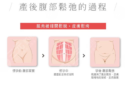 腹部拉皮手術費多少錢？