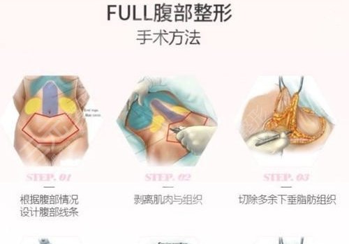 腹部拉皮手術費多少錢？