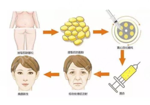 面部脂肪填充的好處和壞處有哪些