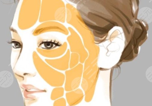面部脂肪填充的好處和壞處有哪些