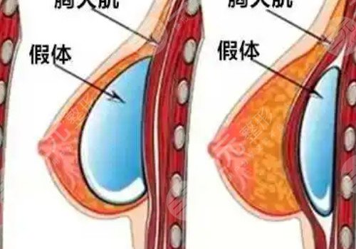 毛面假體和光面假體哪個好?