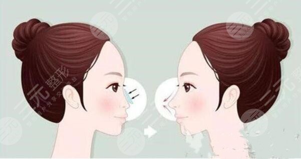 做完媽生鼻或者是直鼻微翹手術(shù)之后需要注意什么?
