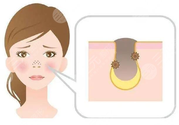 光子或是激光方式