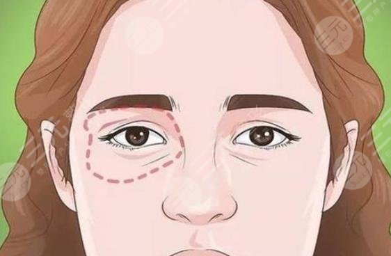 內(nèi)切眼袋多久恢復(fù)正常
