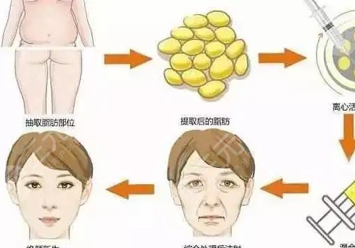 面部脂肪填充多久能恢復(fù)自然？