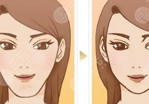 面部輪廓整形包括哪些項目？