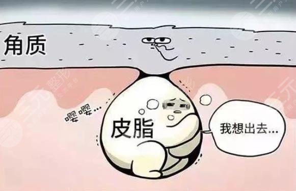 閉合性粉刺是怎么引起的