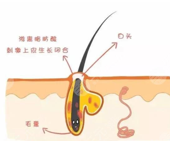 閉合性粉刺怎么調理