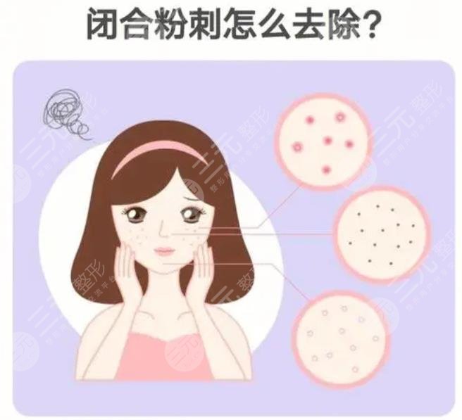 閉合性粉刺怎么調理
