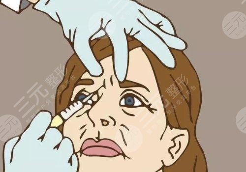 膠原蛋白填充臉部多久恢復自然