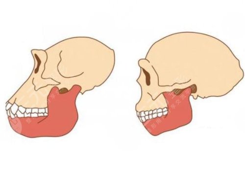 削骨三年后的真實(shí)案例圖片