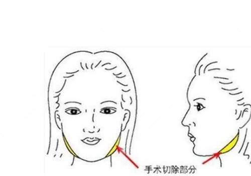 削骨三年后的真實(shí)案例圖片