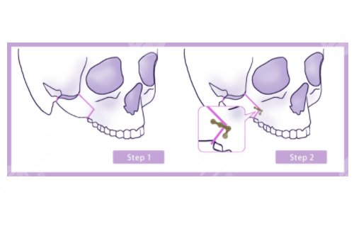削骨三年后的真實(shí)案例圖片