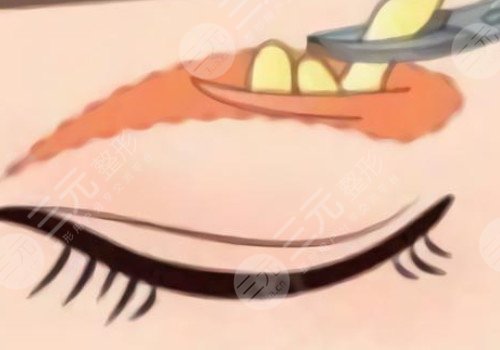 微調整形都有什么項目?