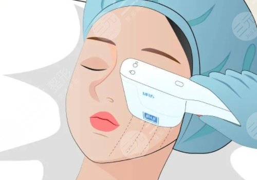 微調整形都有什么項目?