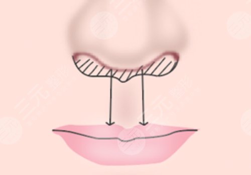 縮短人中的幾種方法