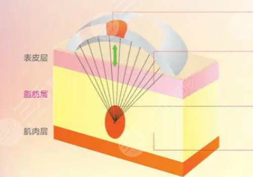 電波拉皮效果好嗎能維持多久？