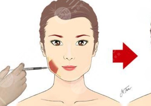 臉部微調(diào)大概多少錢？包括哪些項(xiàng)目？