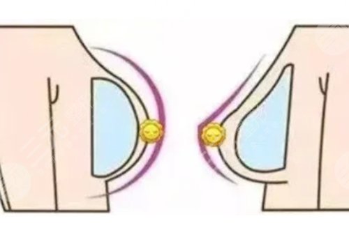 水滴形假體和圓形假體哪個更好看?