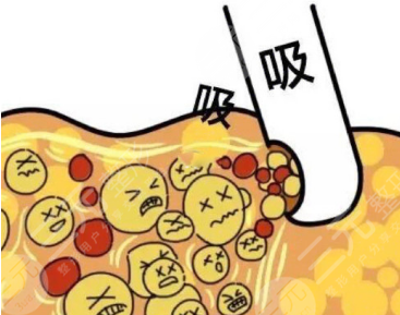 全身抽脂50斤的價(jià)格要5w？