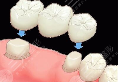 烤瓷牙修復(fù)能美白牙齒嗎？多少錢？使用壽命是幾年？