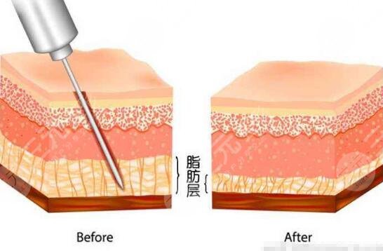 男士乳房肥大吸脂手術(shù)費(fèi)用多少？?jī)r(jià)格標(biāo)準(zhǔn)公開(kāi)！術(shù)前科普~