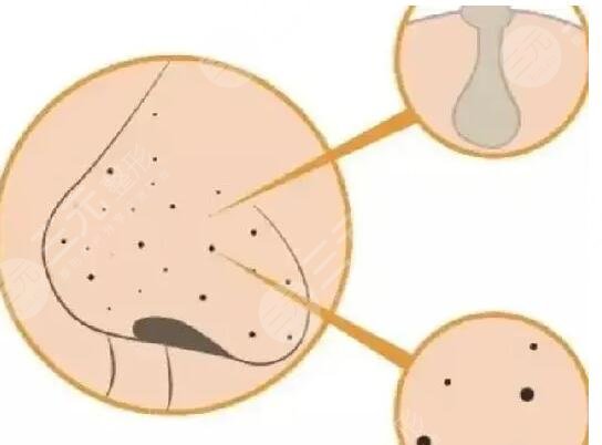 去黑頭什么產(chǎn)品好用一點(diǎn)？真心好用的去黑頭產(chǎn)品大合集！