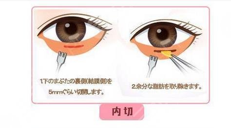 內(nèi)切眼袋多久可以戴隱形眼鏡