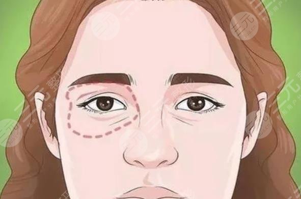 內(nèi)切眼袋多久可以戴隱形眼鏡