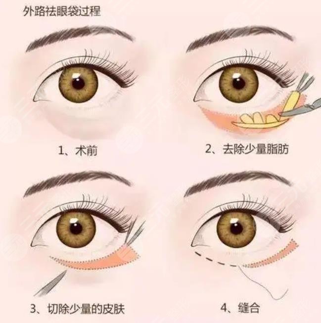 外切眼袋恢復(fù)過(guò)程圖