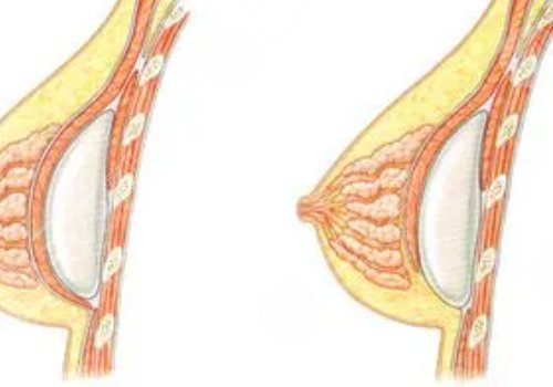 殷初陽(yáng)隆胸手術(shù)好嗎?