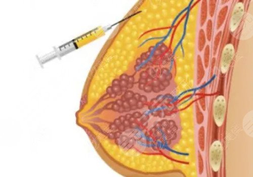 殷初陽(yáng)隆胸手術(shù)好嗎?