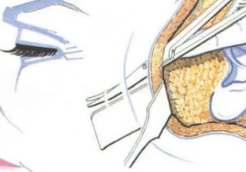 筋膜復(fù)位術(shù)能保持多久?