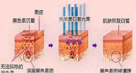 黑臉娃娃跟光子嫩膚有什么區(qū)別？