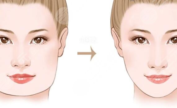 輪廓手術(shù)是怎么做的？