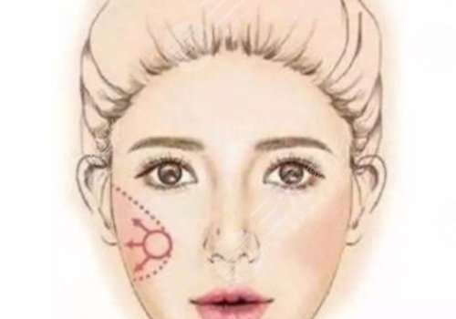 全臉輪廓固定能維持多久