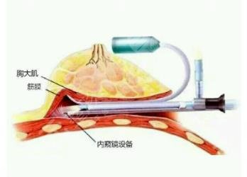 內(nèi)窺鏡隆胸